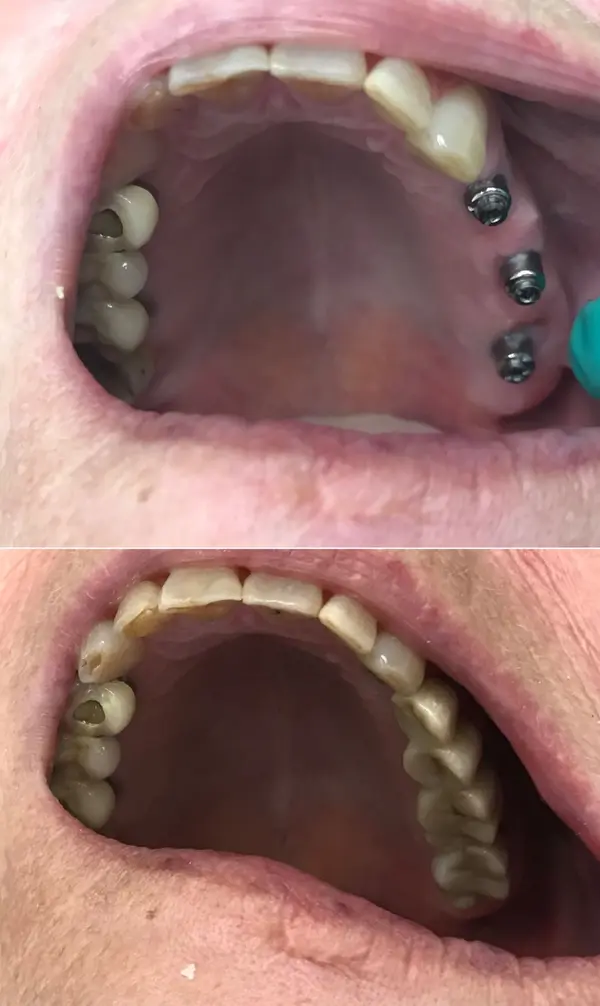 Before and after - missing upper back teeth restored on implants