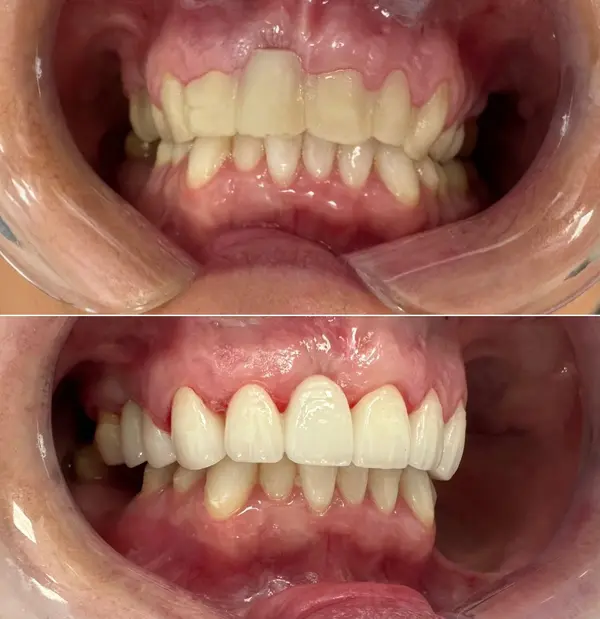 Before and after - upper front teeth esthetic rehabilitation