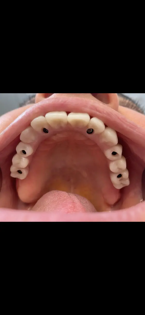 Full bridge on implants upper jaw