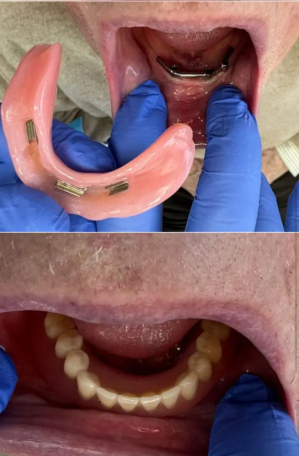 Click prosthesis on implants